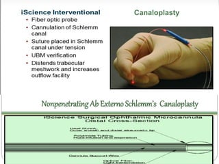 Canaloplasty 
Nonpenetrating Ab Externo Schlemm’s Canaloplasty 
 