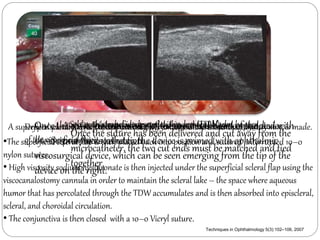 Once the A Secnhtlierme 10–0 Prolene tmchie’rs ctcruaamnbaefcle suture uirsl eoendxepcseoc seoemfd is tied e twthietwh around ci naad ncorawels c(hTeanDstW the bbl)ea end ecdnaen c baen of sneeunla. the device 
ted with 
the iScience prior microcatheter, to its retraction. 
the device is primed with ophthalmic 
viscosurgical device, which can be seen emerging from the tip of the 
device on the right. 
A superficial Deeper spcalerraabloflliacp f lias pc roefa atepdp rwoixthim salitgehlyt l2y5 s0m- atoll e3r0 d0i-m2men tshiiocnksn tehssa,n 4 t.5h a t4 .5 mm, is made. 
Once the suture has been delivered and cut away from the 
microcatheter, the two cut ends must be matched and tied 
together. 
of the superficial flap. 
•The superficial scleral flap is then placed back into position and sutured interrupted 10–0 
nylon sutures. 
• High viscosity sodium hyaluronate is then injected under the superficial scleral flap using the 
viscocanalostomy cannula in order to maintain the scleral lake – the space where aqueous 
humor that has percolated through the TDW accumulates and is then absorbed into episcleral, 
scleral, and choroidal circulation. 
• The conjunctiva is then closed with a 10–0 Vicryl suture. 
Techniques in Ophthalmology 5(3):102–106, 2007 
 