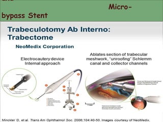 and 
Micro-bypass 
Stent 
 