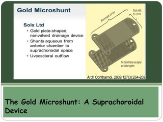 Arch Ophthalmol. 2009;127(3):264-269. 
The Gold Microshunt: A Suprachoroidal 
Device 
 