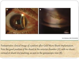 Arch Ophthalmol. 2009;127(3):264-269. 
Postoperative clinical image of a patient after Gold Micro Shunt implantation. 
Note the good position of the shunt in the anterior chamber (A), with no shunt-corneal 
or shunt-iris touching, as seen in the gonioscopic view (B). 
 
