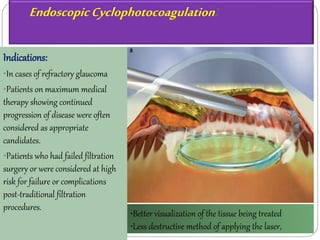 Endoscopic Cyclophotocoagulation : 
Indications: 
•In cases of refractory glaucoma 
•Patients on maximum medical 
therapy showing continued 
progression of disease were often 
considered as appropriate 
candidates. 
•Patients who had failed filtration 
surgery or were considered at high 
risk for failure or complications 
post-traditional filtration 
procedures. 
•Better visualization of the tissue being treated 
•Less destructive method of applying the laser, 
 
