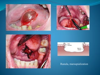 Marsupialization Small Ranula Surgery of Salivary Gland Disorders | PPTX