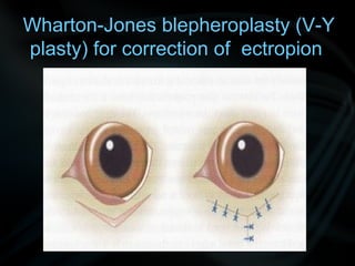 Wharton-Jones blepheroplasty (V-Y
plasty) for correction of ectropion
 