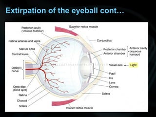 Extirpation of the eyeball cont…
 