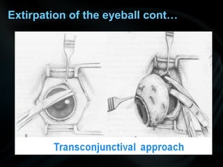 Extirpation of the eyeball cont…
 
