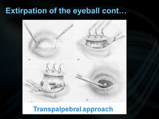 Extirpation of the eyeball cont…
 
