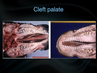 Cleft palate
 