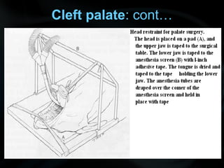 Cleft palate: cont…
 