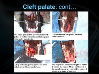 Cleft palate: cont…
 