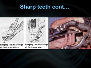 Sharp teeth cont…
 