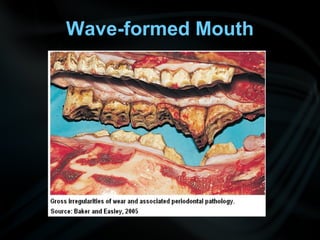 Wave-formed Mouth
 