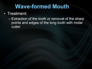• Treatment:
– Extraction of the tooth or removal of the sharp
points and edges of the long tooth with molar
cutter
Wave-formed Mouth
 