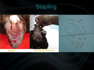 Stapling
 