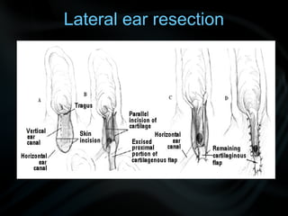 Lateral ear resection
 