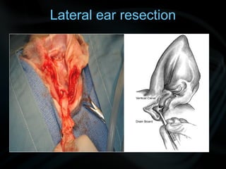 Lateral ear resection
 