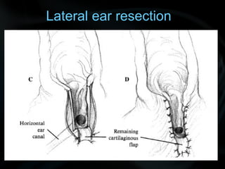 Lateral ear resection
 