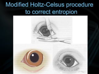 Modified Holtz-Celsus procedure
to correct entropion
 