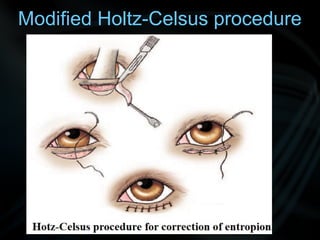 Modified Holtz-Celsus procedure
 