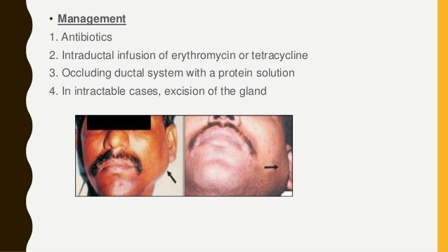 parotid gland swelling parotid swellings