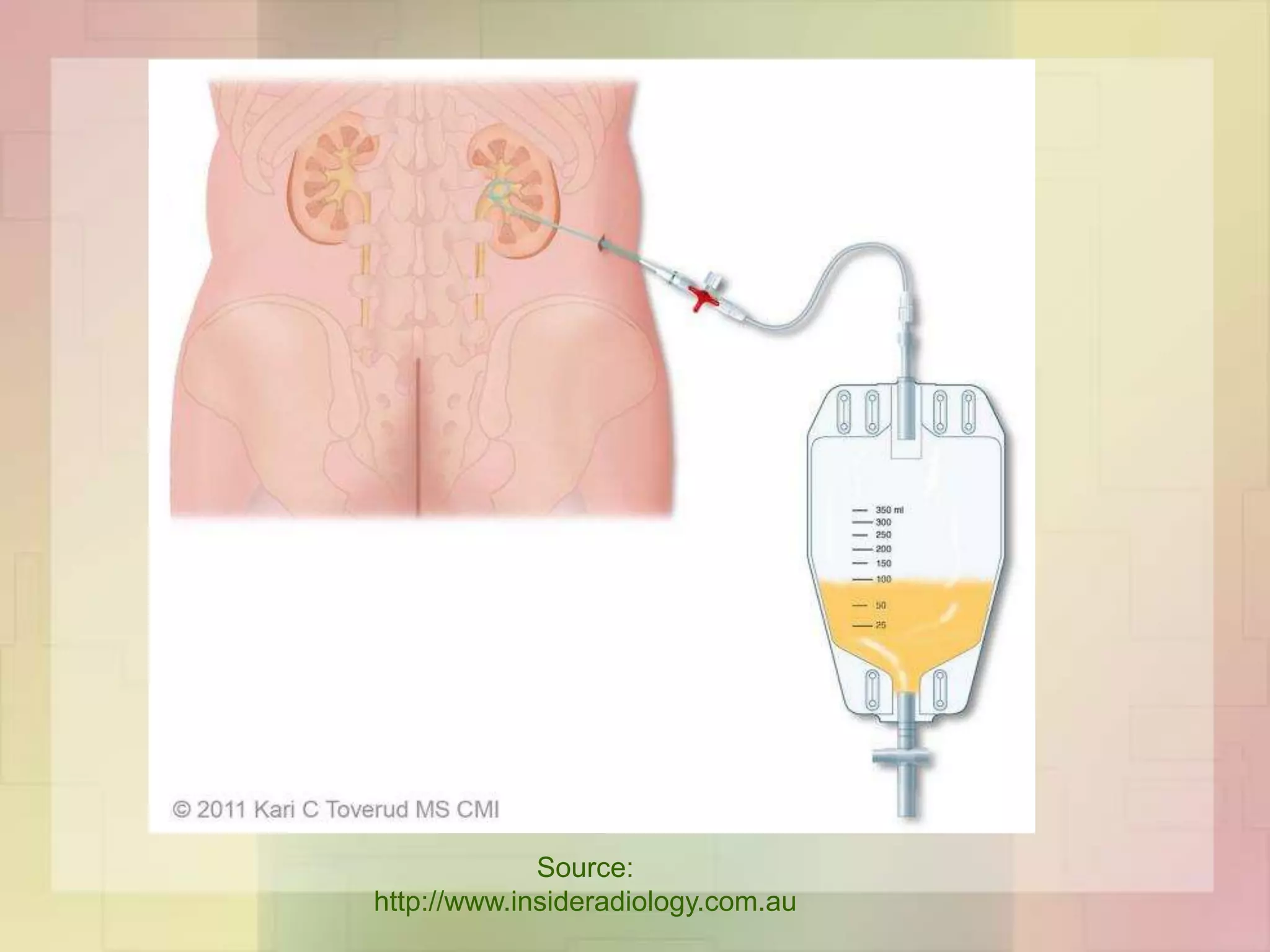 management of upper urinary obstruction | PPTX