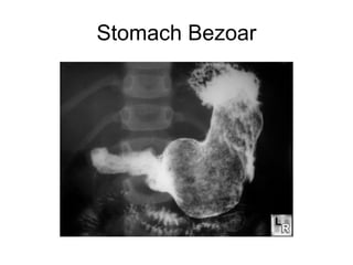 Surgery Stomach & Duodenum Tg | PPT