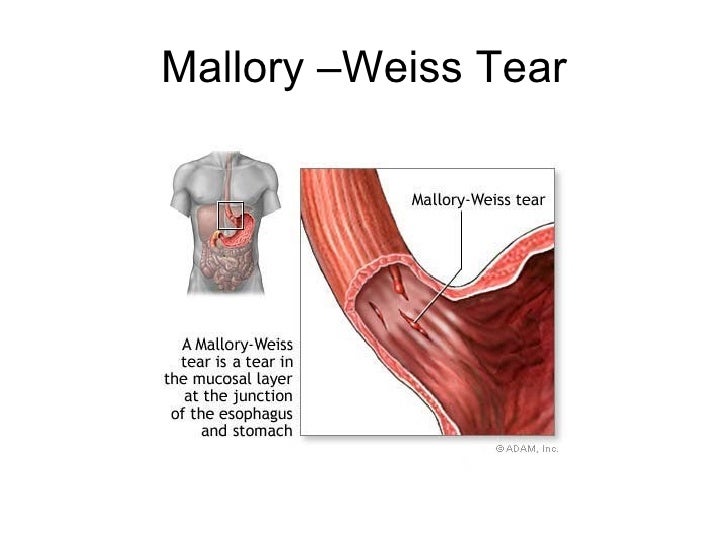MalloryWeiss Syndrome New