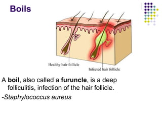 Boils are red lumps around a hair follicle that are tender, warm, and
very painful (signs of inflammation).
- pea-sized to...