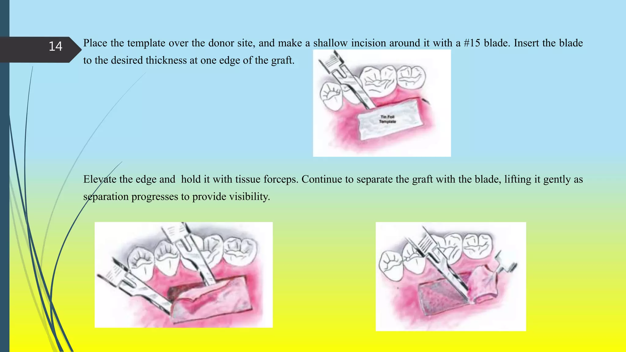 SURGERY TO INCREASE WIDTH OF ATTACHED GINGIVA.pptx