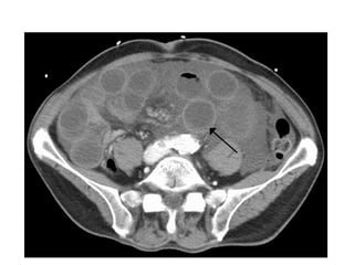 Surgery Ulcerative colitis.pptx
