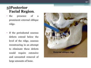 Posterior Ridge Surgical anatomy of periodontal structures, | PPTX