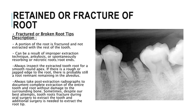 Extraction of retained roots. | PPTX