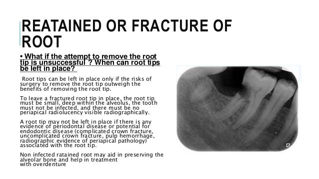 Extraction of retained roots.