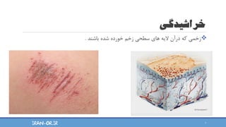 ‫خراشیدگی‬
❖
‫باشند‬ ‫شده‬ ‫خورده‬ ‫زخم‬ ‫سطحی‬ ‫های‬ ‫الیه‬ ‫درآن‬ ‫که‬ ‫زخمی‬
.
7
IRAN-OR.IR
 