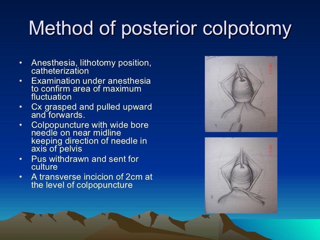 SURGICAL MANAGEMENT OF SEPTIC ABORTION
