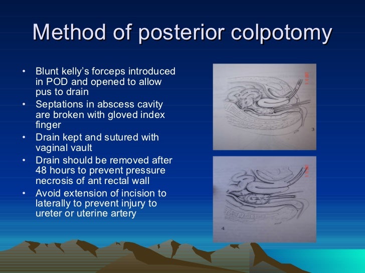 SURGICAL MANAGEMENT OF SEPTIC ABORTION
