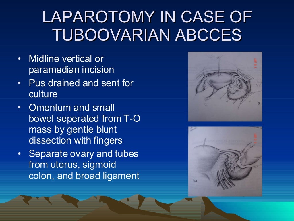 SURGICAL MANAGEMENT OF SEPTIC ABORTION