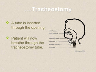 Surgical airway procedures | PPT