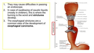 1. They may cause difficulties in passing
an endoscope.
2. In case of swallowing of caustic liquids
(mostly in children), this is where the
burning is the worst and strictures
develop.
3. The esophageal strictures are a
common sites of the development of
esophageal carcinoma.
 