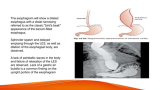 The esophagram will show a dilated
esophagus with a distal narrowing
referred to as the classic "bird's beak"
appearance of the barium-filled
esophagus.
Sphincter spasm and delayed
emptying through the LES, as well as
dilation of the esophageal body, are
observed.
A lack of peristaltic waves in the body
and failure of relaxation of the LES
are observed. Lack of a gastric air
bubble is a common finding on the
upright portion of the esophagram
 
