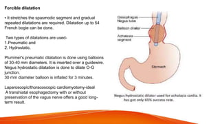 Forcible dilatation
• It stretches the spasmodic segment and gradual
repeated dilatations are required. Dilatation up to 54
French bogie can be done.
Two types of dilatations are used-
1.Pneumatic and
2. Hydrostatic.
Plummer's pneumatic dilatation is done using balloons
of 30-40 mm diameters. It is inserted over a guidewire.
Negus hydrostatic dilatation is done to dilate O-G
junction.
30 mm diameter balloon is inflated for 3 minutes.
Laparoscopic/thoracoscopic cardiomyotomy-ideal
A transhiatal esophagectomy with or without
preservation of the vagus nerve offers a good long-
term result.
 