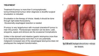 TREATMENT
Treatment-if tumour is more than 5 cm/symptomatic
tumour/intraluminal tumour when diagnosis is doubtful surgical
enucleation is indicated.
Enucleation is the therapy of choice. Ideally it should be done
through right-sided thoracotomy.
Occasionally esophageal resection is needed
If tumour is very large/tumour with mucosal ulceration/if tumour is
near OG junction. Thoracoscopic resection can be done. Leak,
empyema, sepsis and stricture are the occasional Complications
Unlike in the stomach and intestine (gastric leiomyoma more than
6 cm intestinal leiomyoma more than 4 cm are potentially
malignant) increased size of the oesophageal leiomyoma does not
predispose the malignant transformation.
 