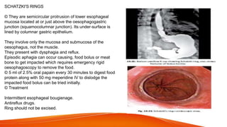 SCHATZKI'S RINGS
© They are semicircular protrusion of lower esophageal
mucosa located at or just above the oesophagogastric
junction (squamocolumnar junction). Its under-surface is
lined by columnar gastric epithelium.
They involve only the mucosa and submucosa of the
oesophagus, not the muscle.
They present with dysphagia and reflux.
Episodic aphagia can occur causing, food bolus or meat
bone to get impacted which requires emergency rigid
oesophagoscopy to remove the food.
© 5 ml of 2.5% oral papain every 30 minutes to digest food
protein along with 50 mg meperidine IV to dislodge the
impacted food bolus can be tried initially.
© Treatment
Intermittent esophageal bougienage.
Antireflux drugs.
Ring should not be excised.
 