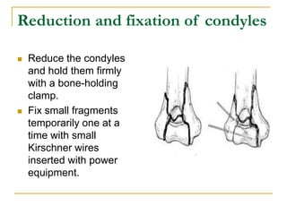 Condyle Pin Elbow anatomy of elbow & fractures around elbow & surgical options in adults ...