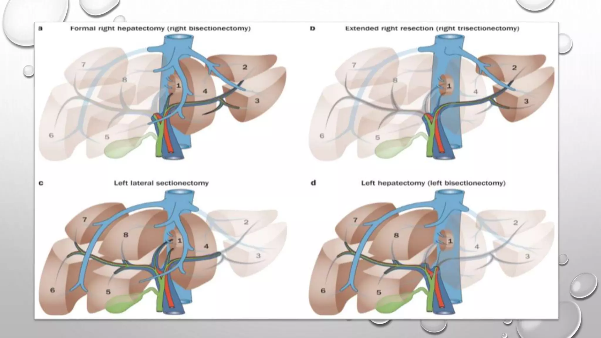 Surgical anatomy of liver | PPTX