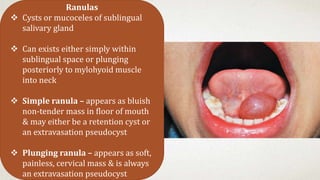 Ranula And Sublingual Salivary Gland – KXAEML