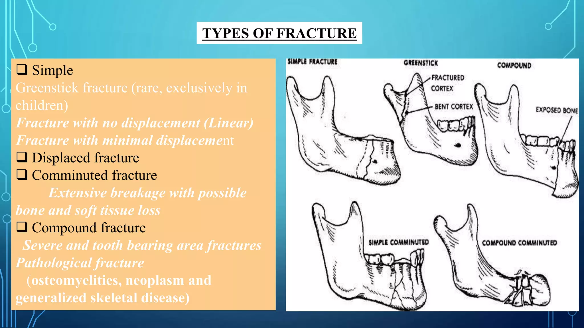 TYPES OF FRACTURE
 Simple
Greenstick fracture (rare, exclusively in
children)
Fracture with no displacement (Linear)
Fracture with minimal displacement
 Displaced fracture
 Comminuted fracture
Extensive breakage with possible
bone and soft tissue loss
 Compound fracture
Severe and tooth bearing area fractures
Pathological fracture
(osteomyelities, neoplasm and
generalized skeletal disease)
 