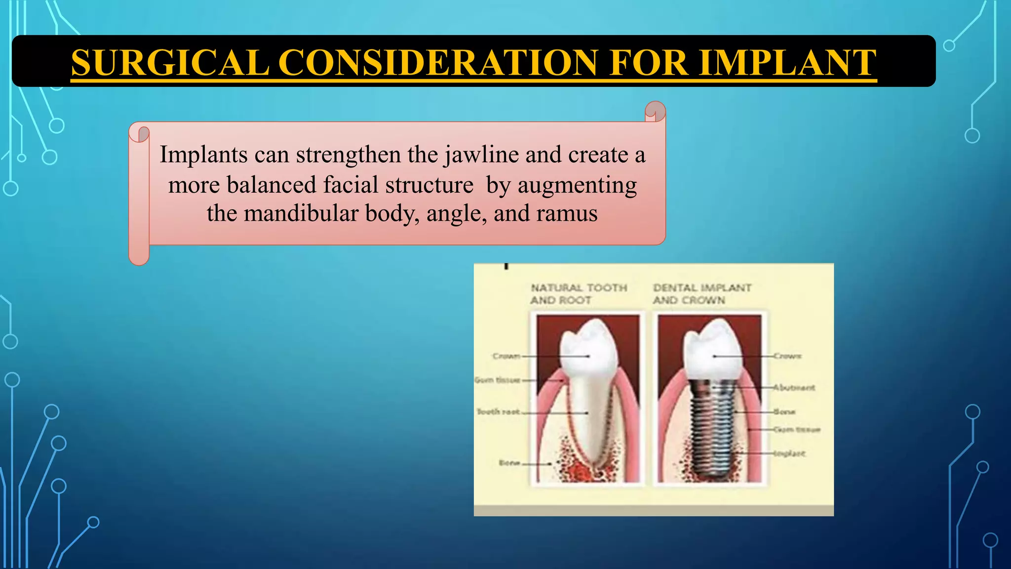 SURGICAL CONSIDERATION FOR IMPLANT
Implants can strengthen the jawline and create a
more balanced facial structure by augmenting
the mandibular body, angle, and ramus
 