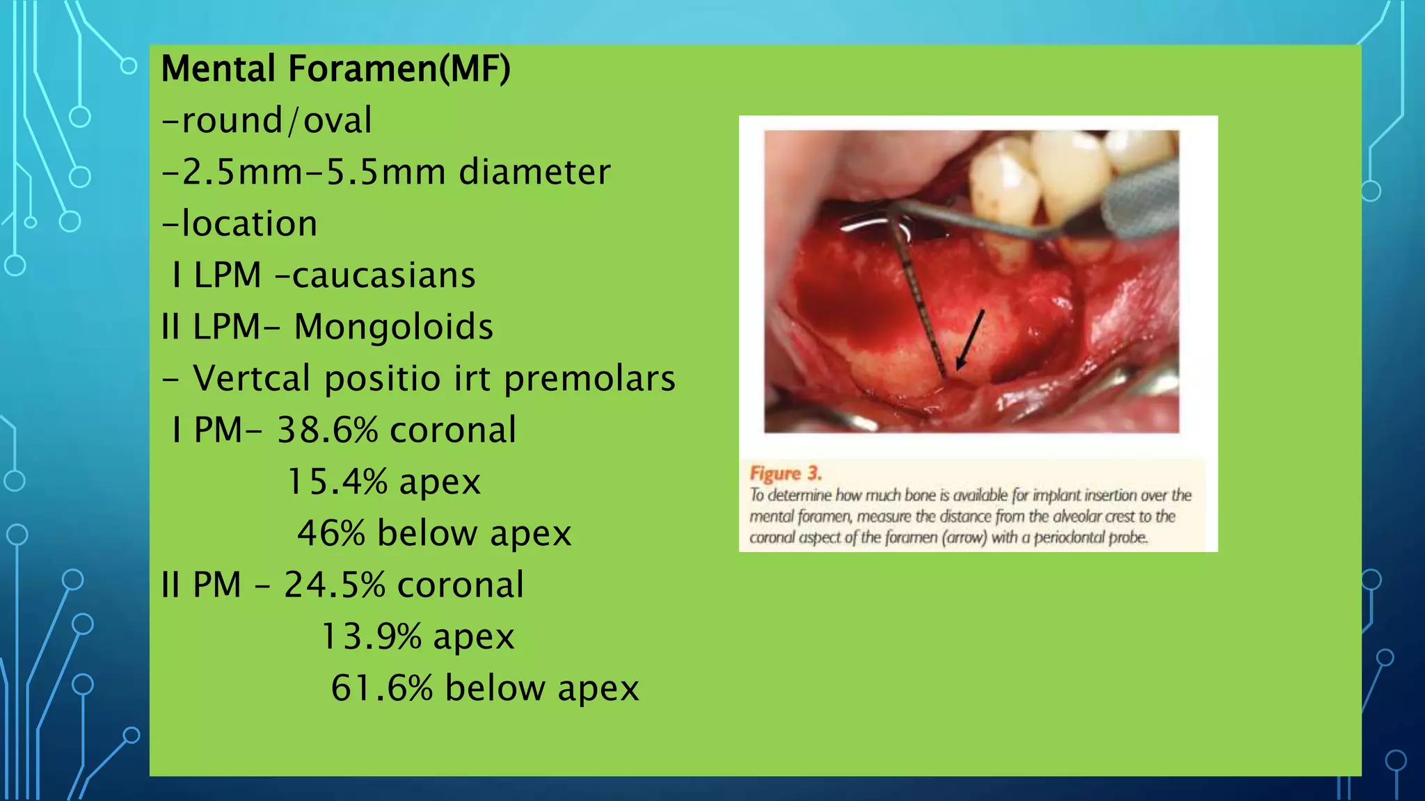 Mental Foramen(MF)
-round/oval
-2.5mm-5.5mm diameter
-location
I LPM –caucasians
II LPM- Mongoloids
- Vertcal positio irt premolars
I PM- 38.6% coronal
15.4% apex
46% below apex
II PM – 24.5% coronal
13.9% apex
61.6% below apex
 
