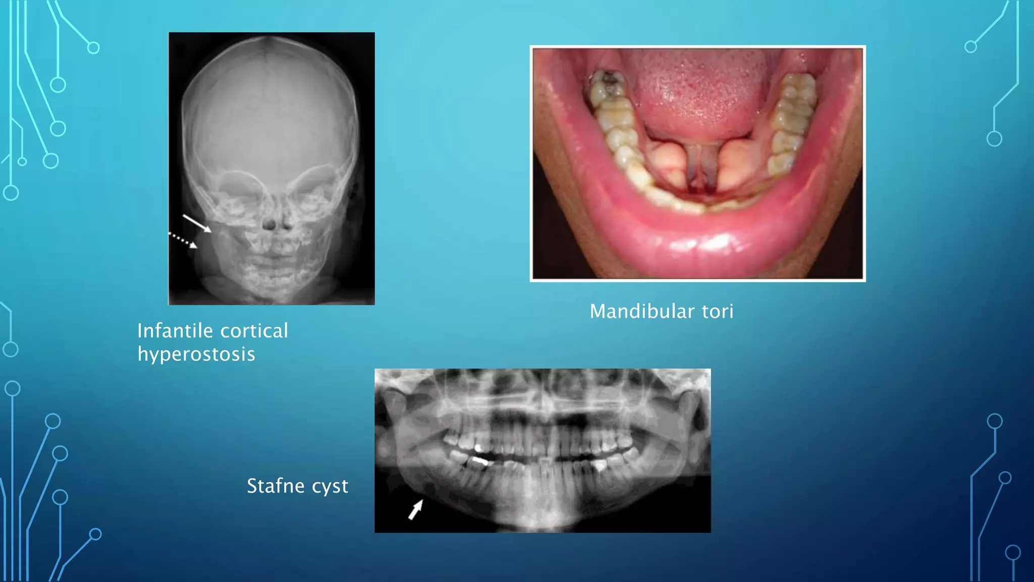 Infantile cortical
hyperostosis
Stafne cyst
Mandibular tori
 